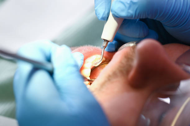 Best Emergency Tooth Extraction in Madison, MN