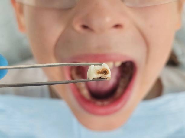 Best Emergency Tooth Extraction in Madison, MN
